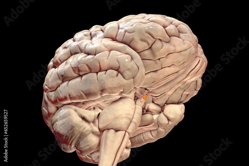 A pituitary gland tumor, 3D illustration photo