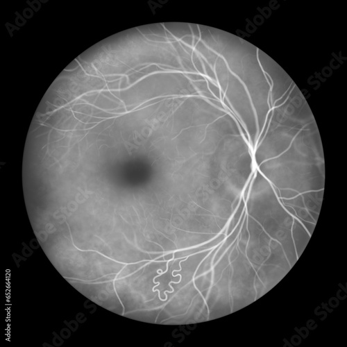 Retinal arteriovenous malformation, illustration photo