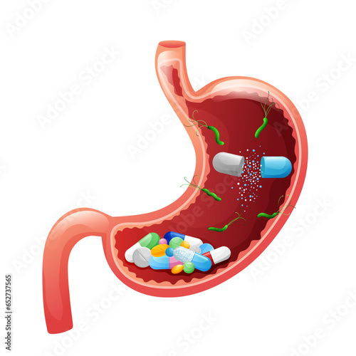 Human stomach with drug capsules, tablets, pills and helicobacter pylori inside