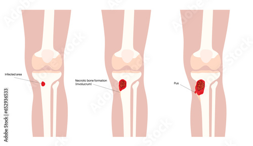 Tibia bone osteomyelitis