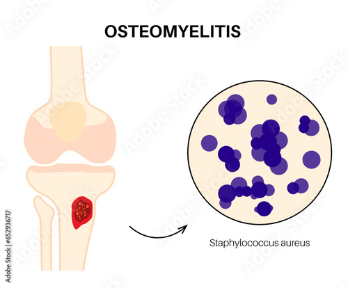 Tibia bone osteomyelitis photo