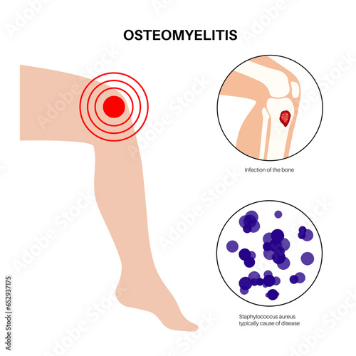 Tibia bone osteomyelitis