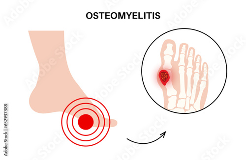 Osteomyelitis of feet photo