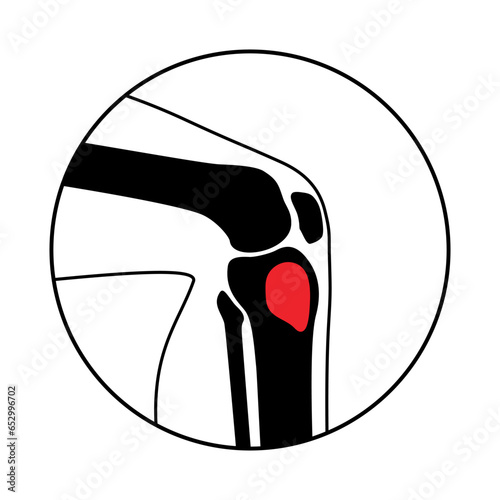 Tibia bone osteomyelitis photo