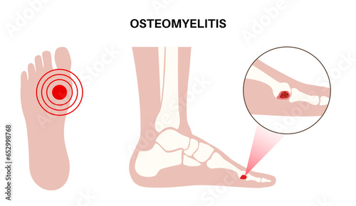Osteomyelitis of feet