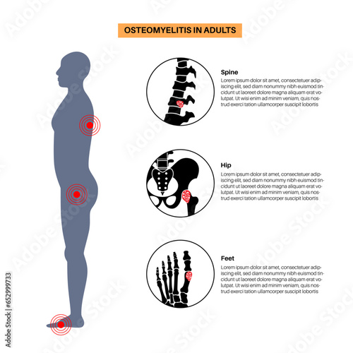 Osteomyelitis in adults