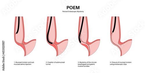 POEM medical poster