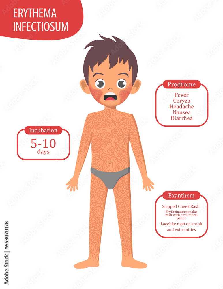 Boy with Erythema Infectiosum Parvovirus B19 Rash Viral Exanthem Series ...
