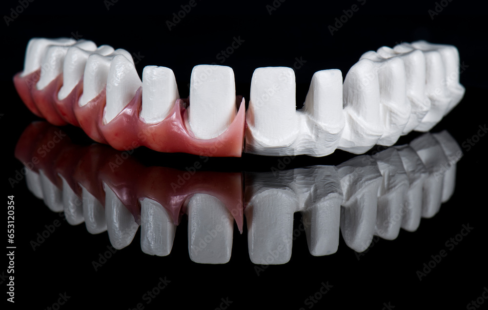 Obraz premium max natural look crowns on implants