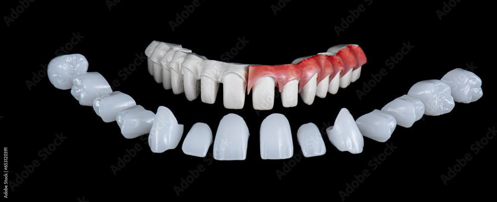 Obraz premium max natural look crowns on implants