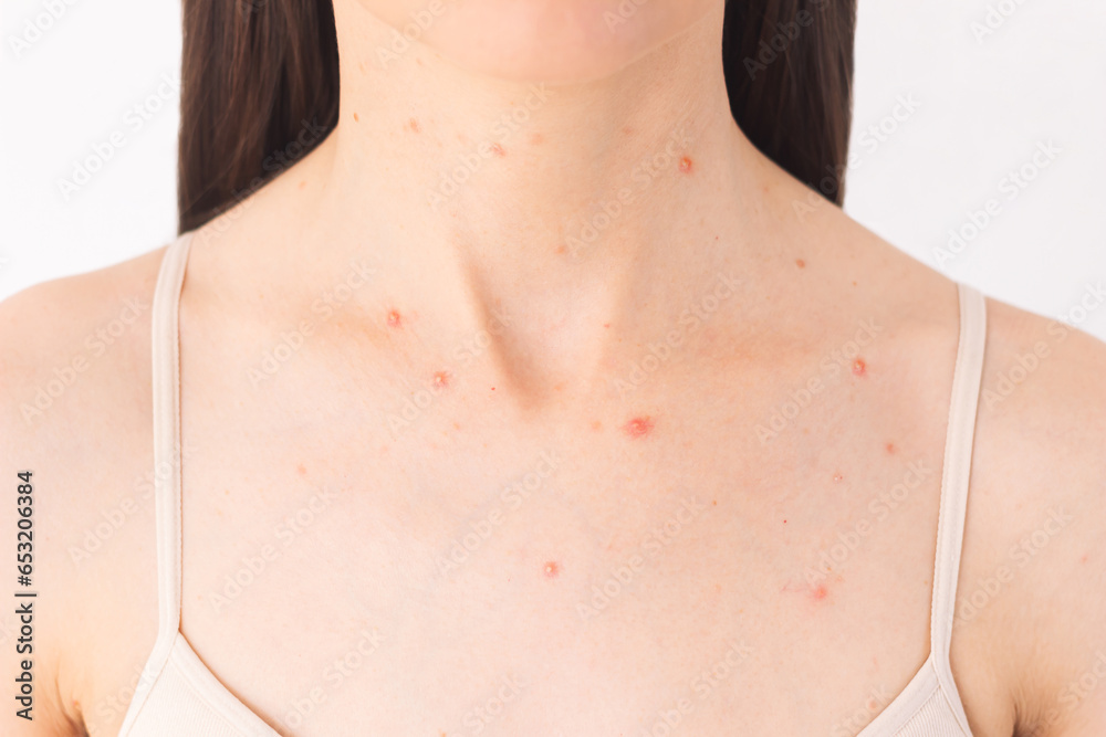 close-up photo of a young dark-haired woman with acne in the chest and neck. Skin diseases. Adolescence. Hormonal disorders. Isolated on a white background.