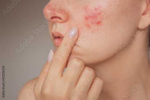 close-up photo of a young Caucasian woman suffering from the skin chronic disease rosacea on her face in the acute stage. Pink acne. Dermatological problems.  isolated on a beige background photo