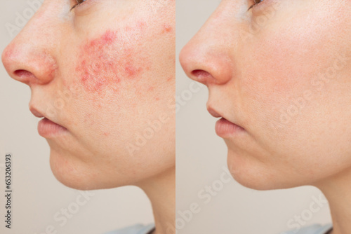 face comparison of a young Caucasian woman suffering from the skin chronic disease rosacea on her face in the acute stage. Before and after treatment. Pink acne. Dermatological problems. photo