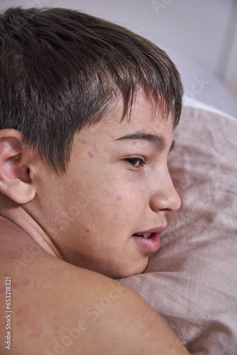 Skin itching, dermatitis, food allergy on the face. A boy with red spots. The child has itching, on the face with an allergic rash.