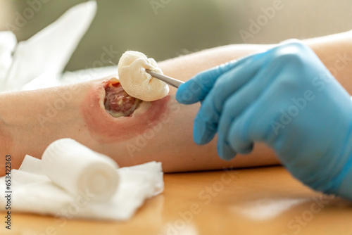 Wound care concept: Symbolizing change of dressing and cleaning and debridement of a wound with a realistic fake wound photo