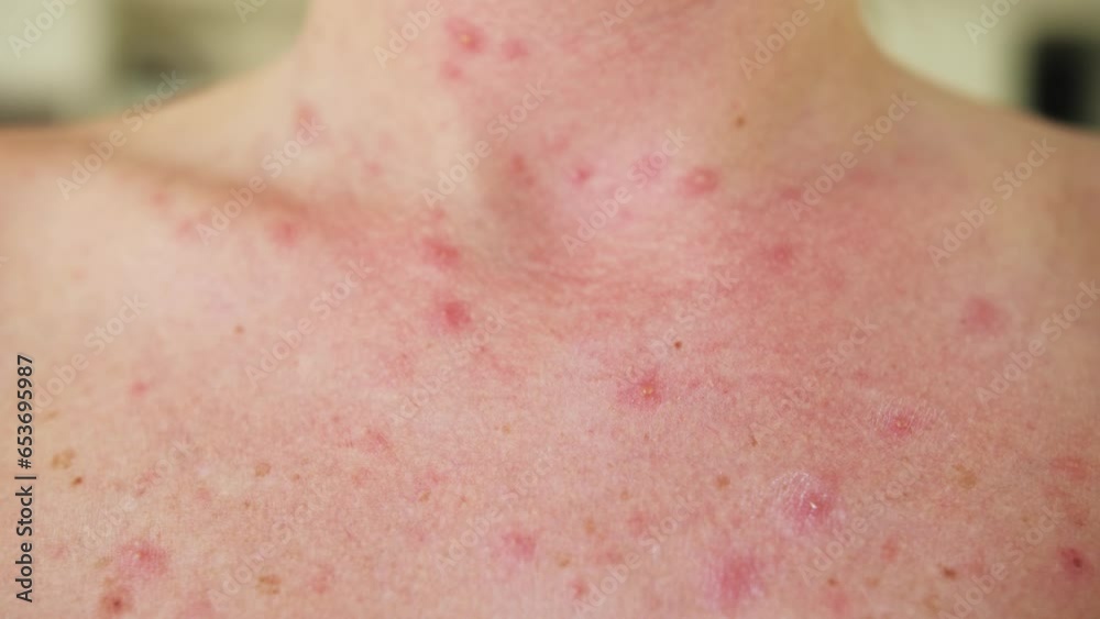 Close-up of chicken pox on the breast of an adult person. Close-up of chicken pox on the breast of an adult person.