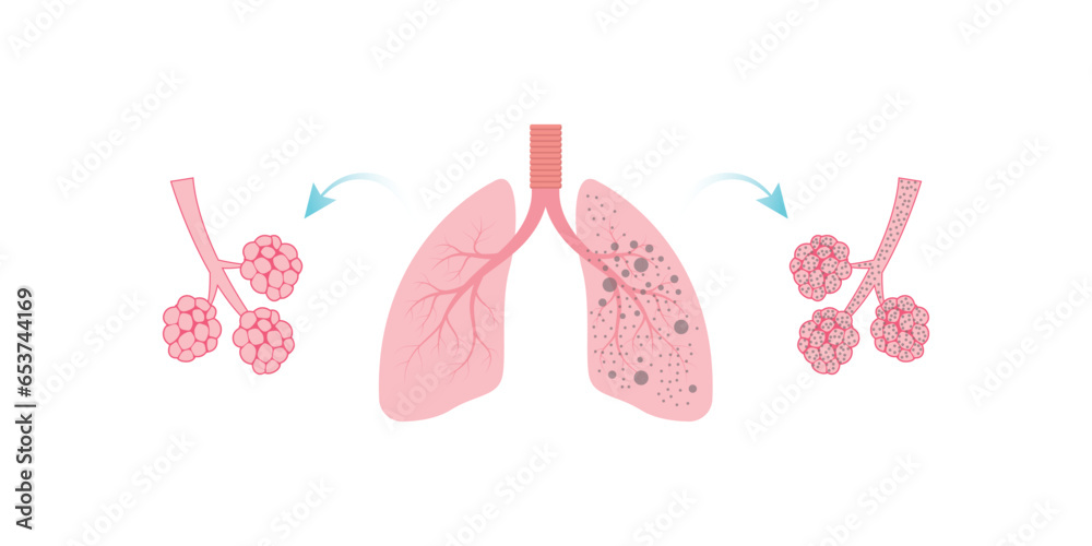 Silicosis Pulmonary Fibrosis Concept Design. Vector Illustration.