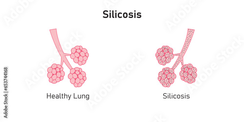 Silicosis Pulmonary Fibrosis Concept Design. Vector Illustration.
