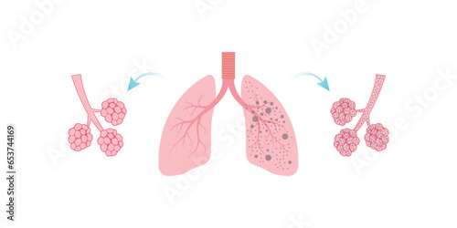 Silicosis Pulmonary Fibrosis Concept Design. Vector Illustration.