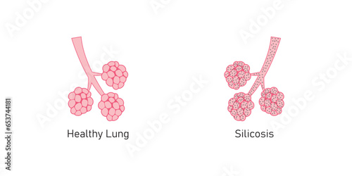 Silicosis Pulmonary Fibrosis Concept Design. Vector Illustration.