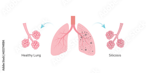 Silicosis Pulmonary Fibrosis Concept Design. Vector Illustration.