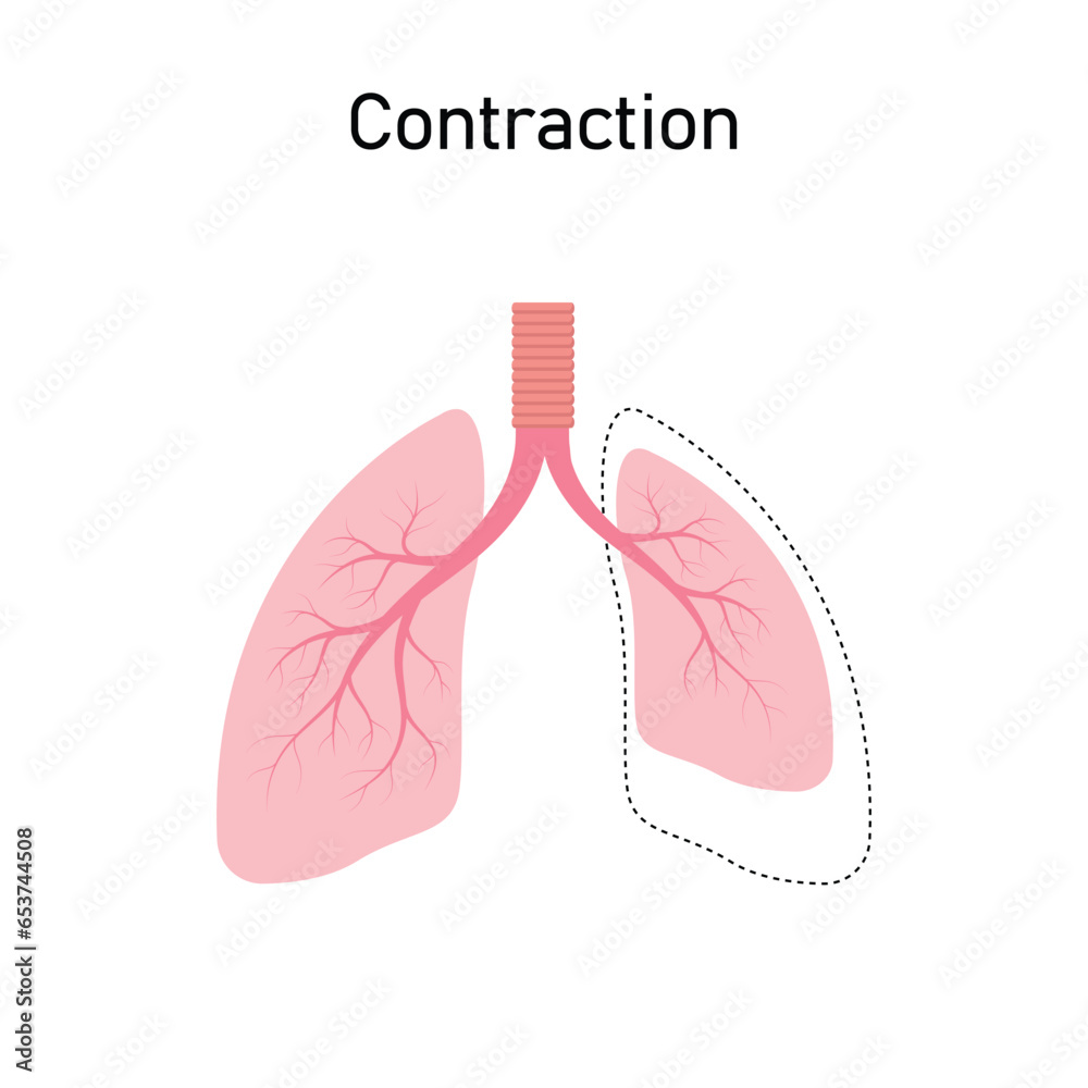 Contraction Atelectasis Concept Design. Vector Illustration. Contraction Atelectasis Concept Design. Vector Illustration.