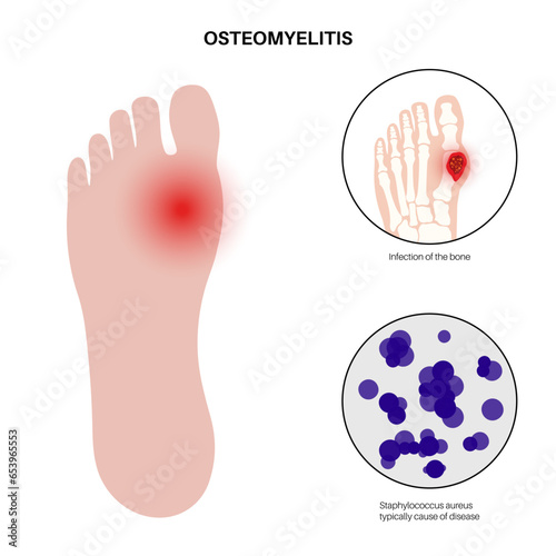 Osteomyelitis of feet