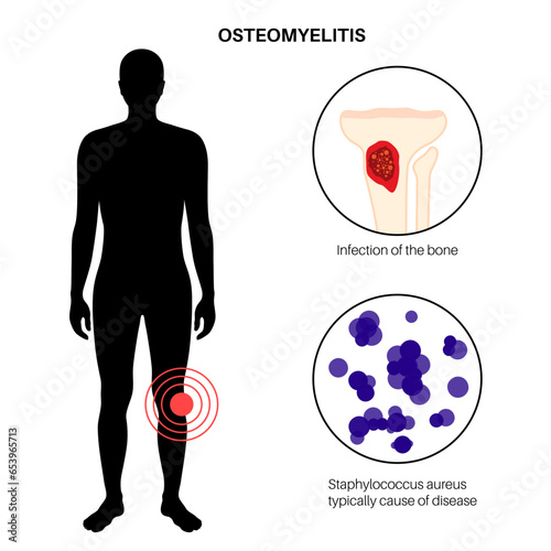 Tibia bone osteomyelitis