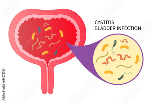 urinary tract infection with the E coli and C diff fungal germ cause frequent urge urination or Bloody urine pelvic painful