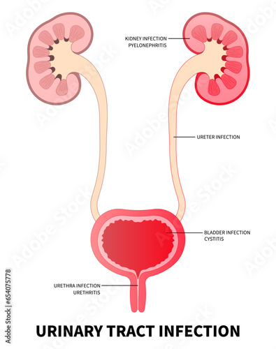The kidney ureter bladder inflammation of urinary tract infection with the E coli and C diff fungal germ cause frequent urge urination or Bloody urine pelvic painful in medical photo