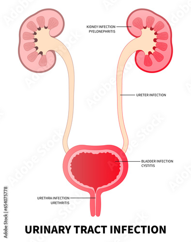 The kidney ureter bladder inflammation of urinary tract infection with the E coli and C diff fungal germ cause frequent urge urination or Bloody urine pelvic painful in medical