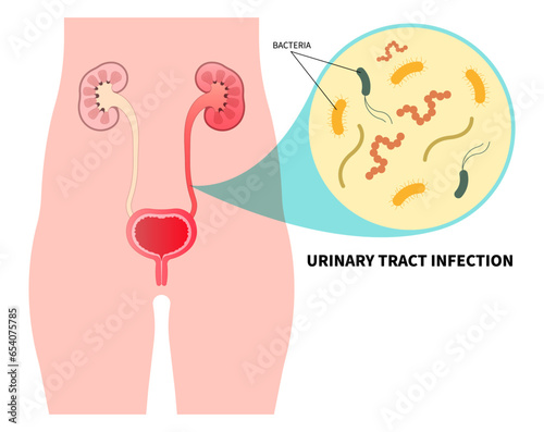 Kidney stone that lead to bacteria infection of urinary tract with the E coli and C diff fungal germ cause frequent urge urination or Bloody urine pelvic painful