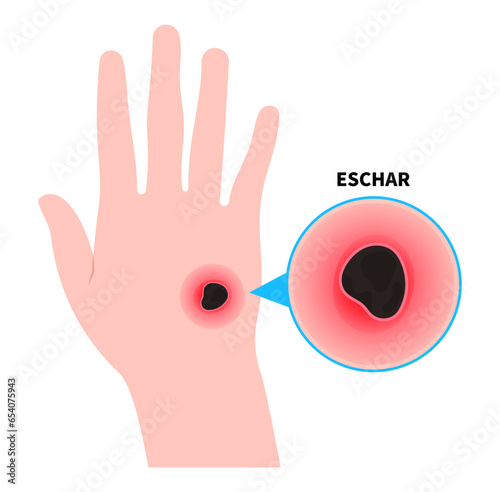 Wounds on hand and skin infection with eschar or scrub typhus the bacteremia sepsis in diabetes patient