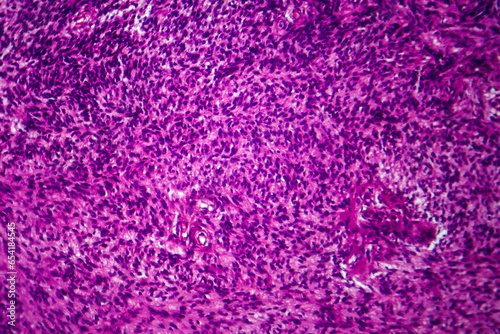 Fibrosarcoma, light micrograph
