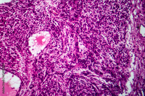 Fibrosarcoma, light micrograph photo