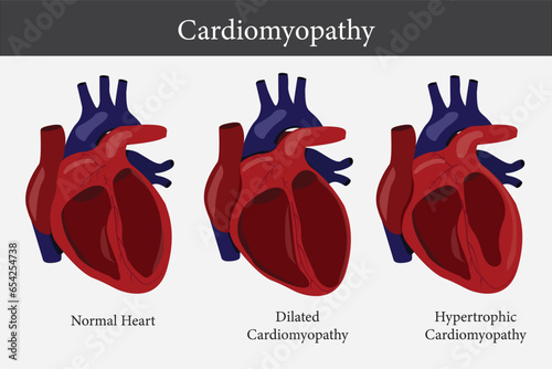 Cardiomyopathy. Healthy heart and heart with enlarged and thickened muscle. cross section of human's heart. eps 10