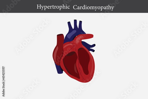 Cardiomyopathy. Healthy heart and heart with enlarged and thickened muscle. cross section of human's heart. eps 10 photo