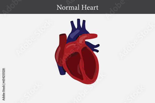 Cardiomyopathy. Healthy heart and heart with enlarged and thickened muscle. cross section of human's heart. eps 10