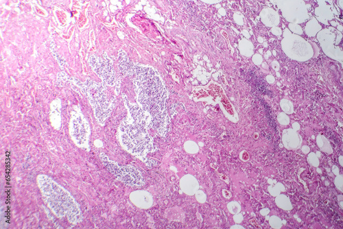 Small cell lung cancer, light micrograph photo