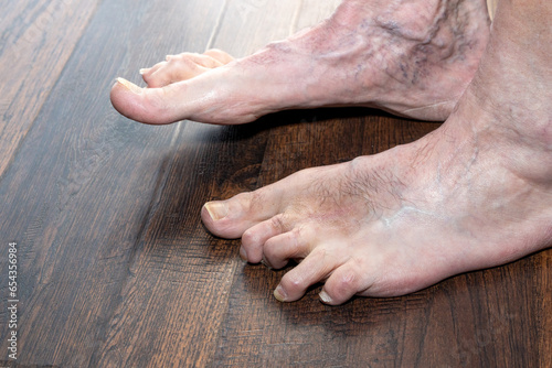 Man's deformed hammertoes showing left foot one year after surgery showing multiple conditions including toenail fungus and phlebitis. photo