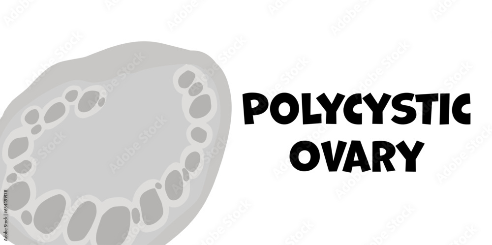Polycystic Ovary Syndrome themed background Stock Vector | Adobe Stock