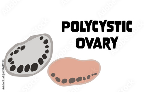 Polycystic Ovary Syndrome themed background
