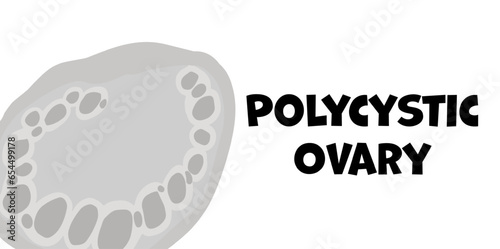 Polycystic Ovary Syndrome themed background