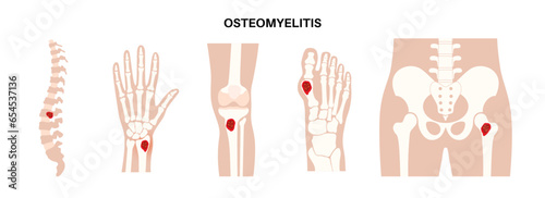 Osteomyelitis disease poster