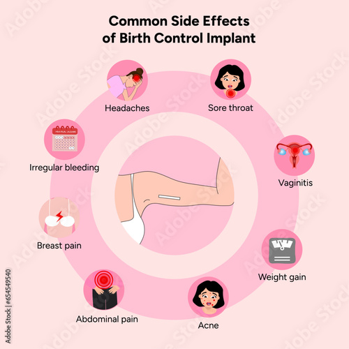 Common side effects of birth control implant, medical information and illustration