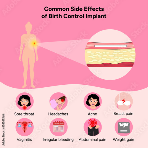 Common side effects of birth control implant, medical information 