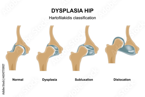 Dysplasia hip stages illustration photo