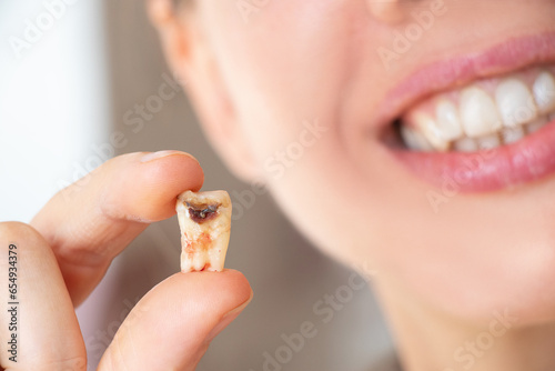 A girl in her hand holds a pulled out tooth with a black hole in the middle of the tooth close-up, a sick tooth in her hand after removal that could not be restored, dentistry, dental
