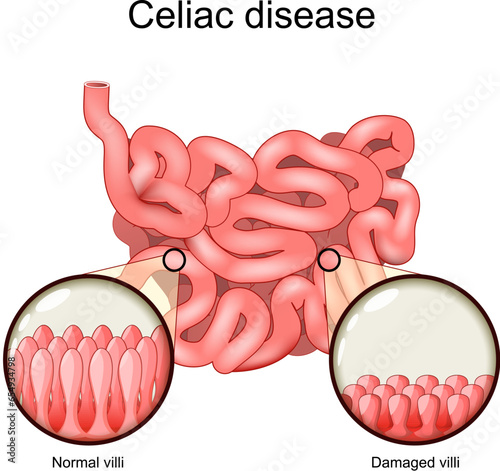 Celiac disease. cross section of a small intestine