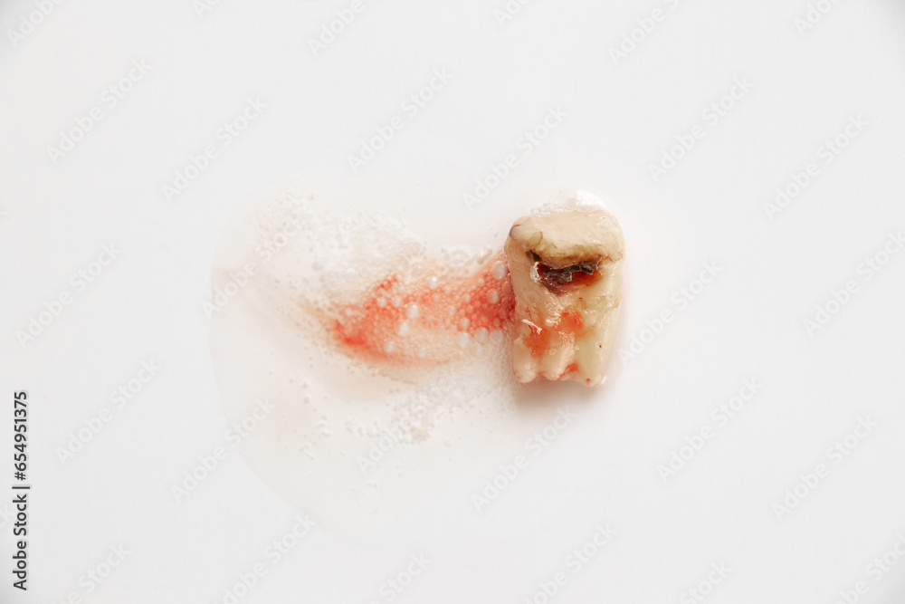 An extracted tooth destroyed by caries and a hole in the middle lies on